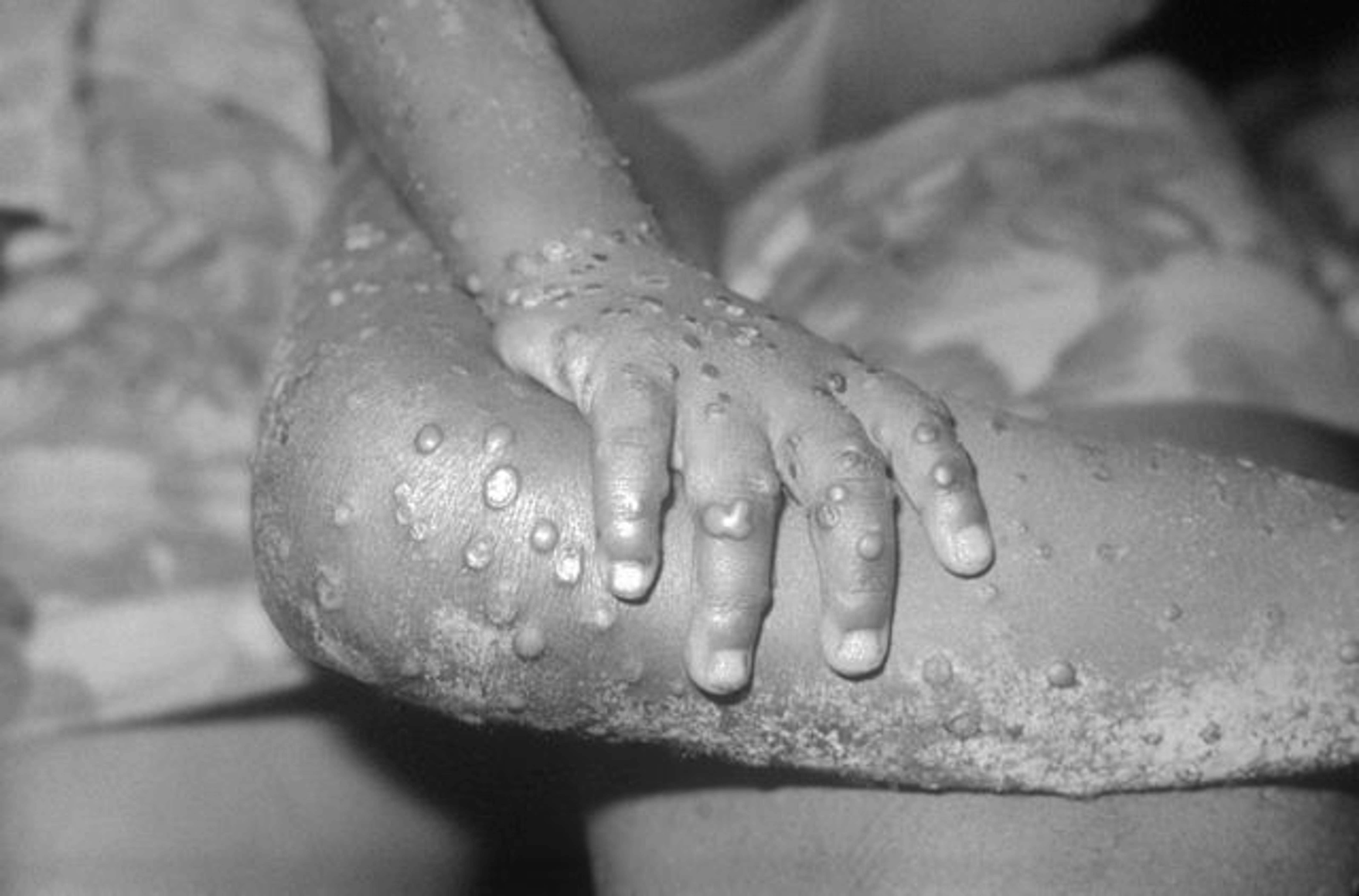 Analysis: Should You Be Afraid Of A Monkeypox Pandemic?