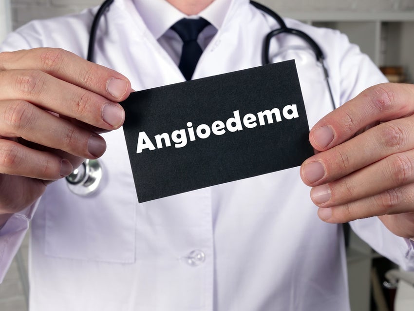 Medical concept meaning Angioedema with sign on the sheet.